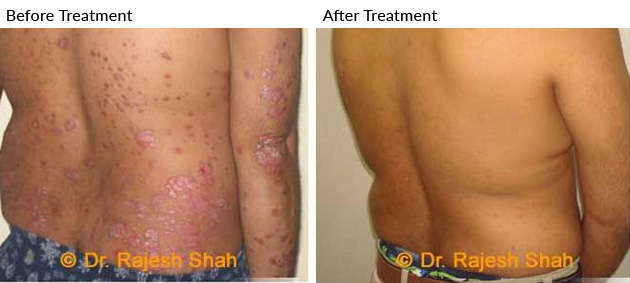 Psoriasis Treatment Before and After